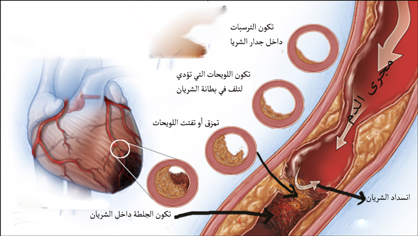 كيفية حدوث الإنسداد داخل الشريان التاجي