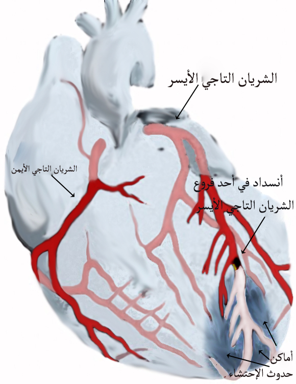 إحتشاء عضلة القلب في الأزمة القلبية