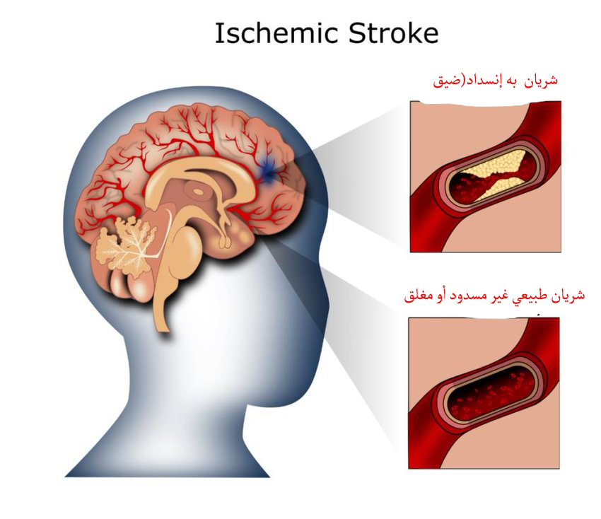 السكتة الدماغية