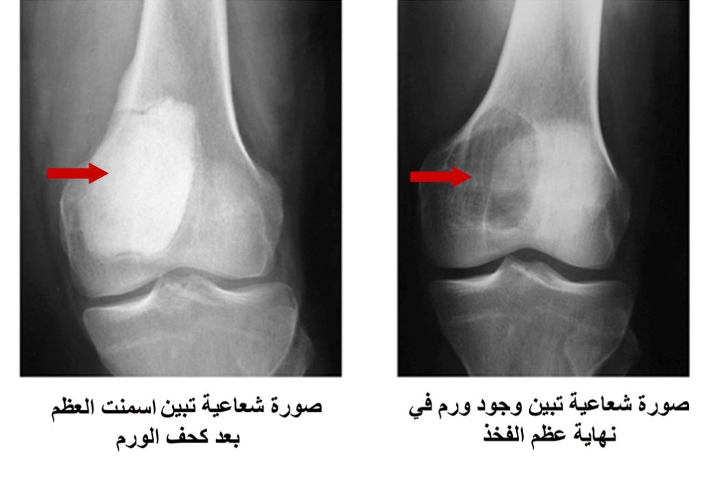 سرطان العظام