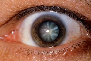 getty_rm_photo_of_cataract