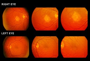 getty_rm_photo_of_macular_degeneration