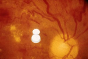 getty_rm_photo_of_retinopathy