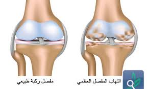 التهاب المفاصل عند الاطفال مقالات منصة القارئ العربى
