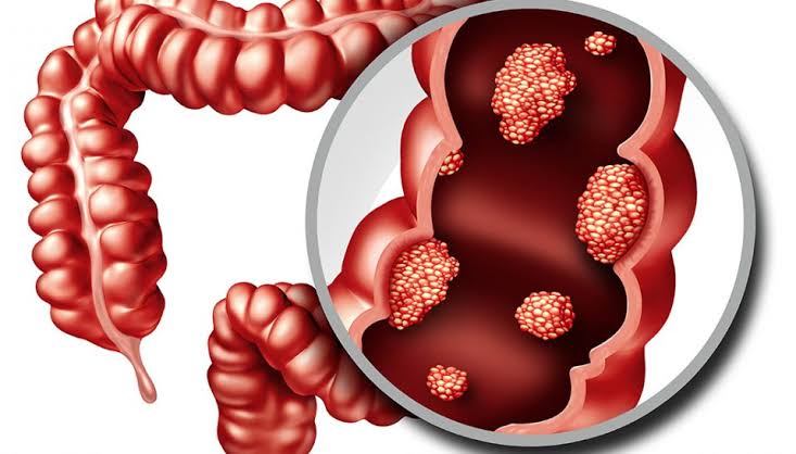 الوقاية من سرطان القولون و المستقيم
