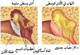 إلتهاب الأذن الوسطى