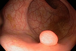 phototake_rm_of_polyp_in_the_colon