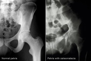 princ_rm_of_xray_of_pelvis_with_osteomalacia