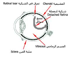 أعراض إنفصال شبكية العين