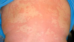 urticaria_342x198_ADNYDN