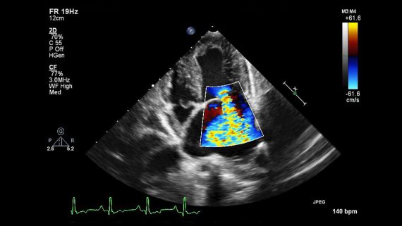  تخطيط صدى القلب بالجهد stress echocardiography لعلاج الأزمة القلبية