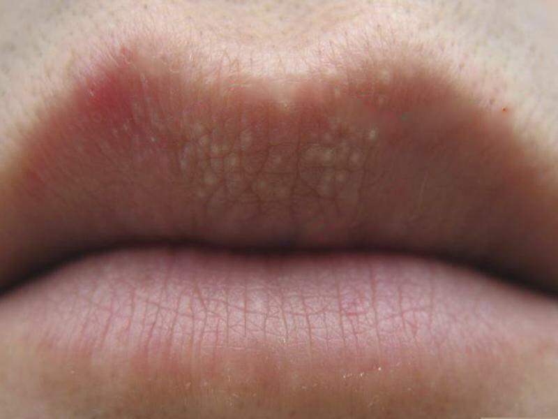 Kleine Weiße Punkte Fordyce Drüsen Lippe mklat.com