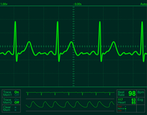 تخطيط كهربية القلب (رسم القلب Electrocardiogram)
