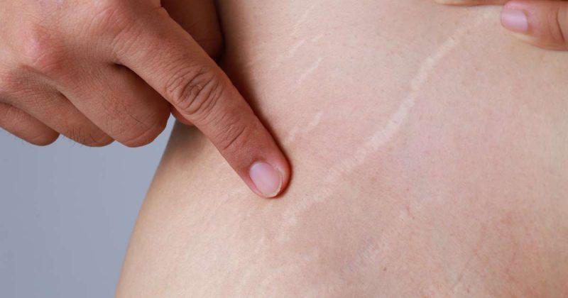 علاج علامات تمدد الجلد