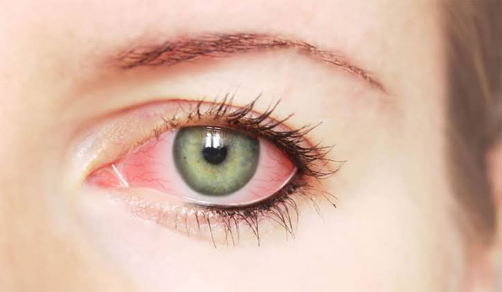 متلازمة جفاف العين من أمراض العيون